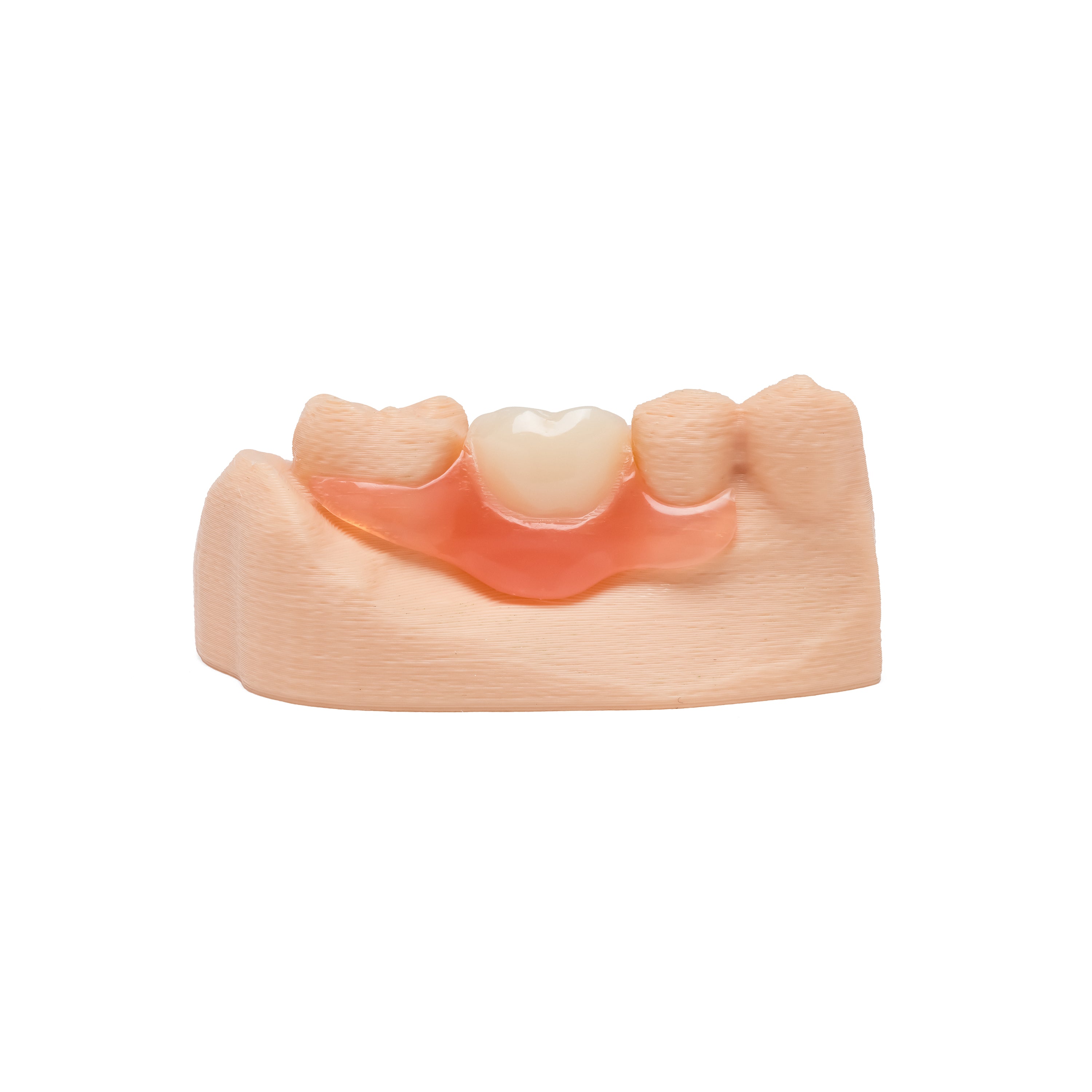 Single posterior back tooth flexible partial denture placed on a dental model on white background.