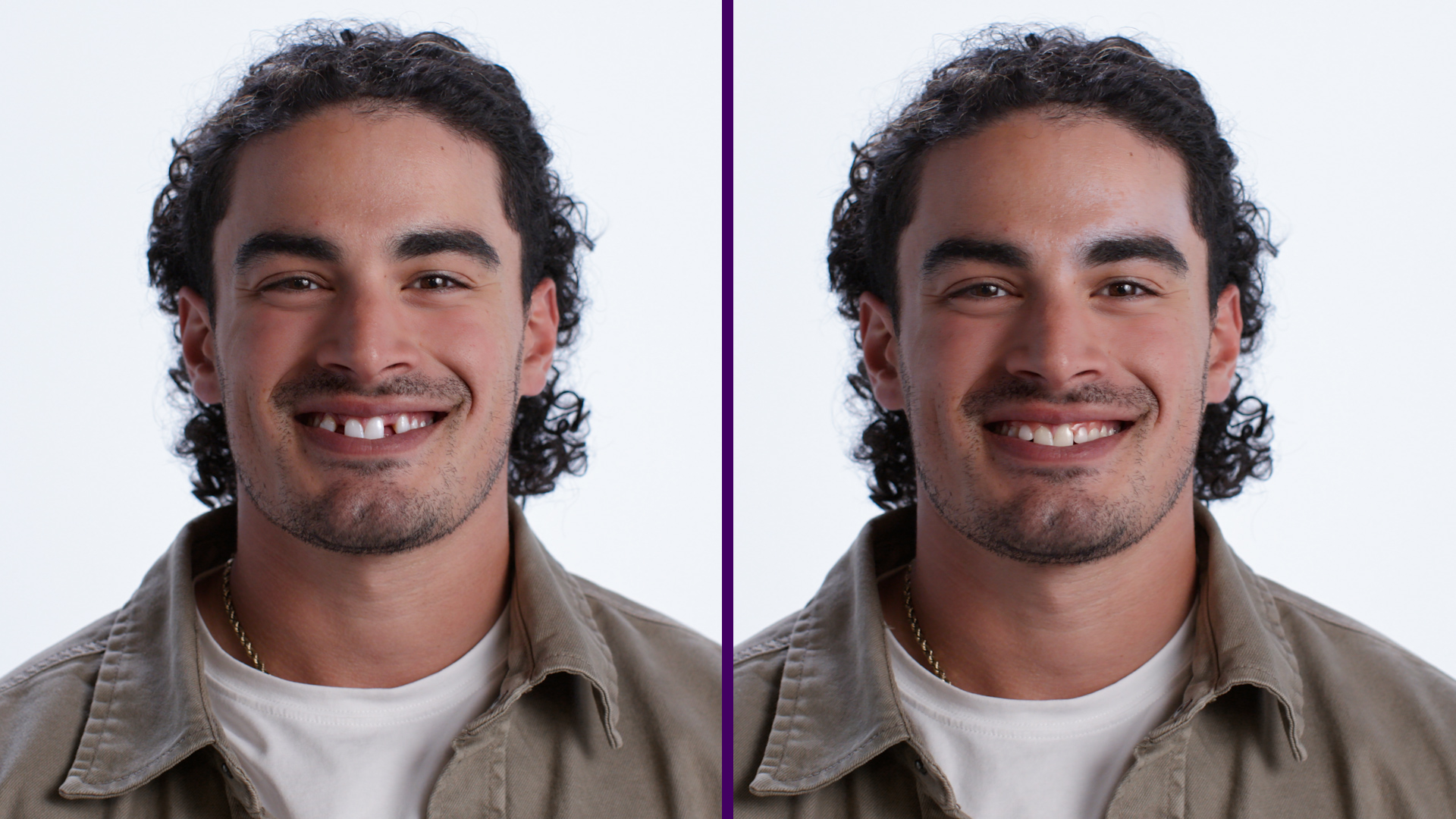 Photo of One Arch Lower Partial Denture