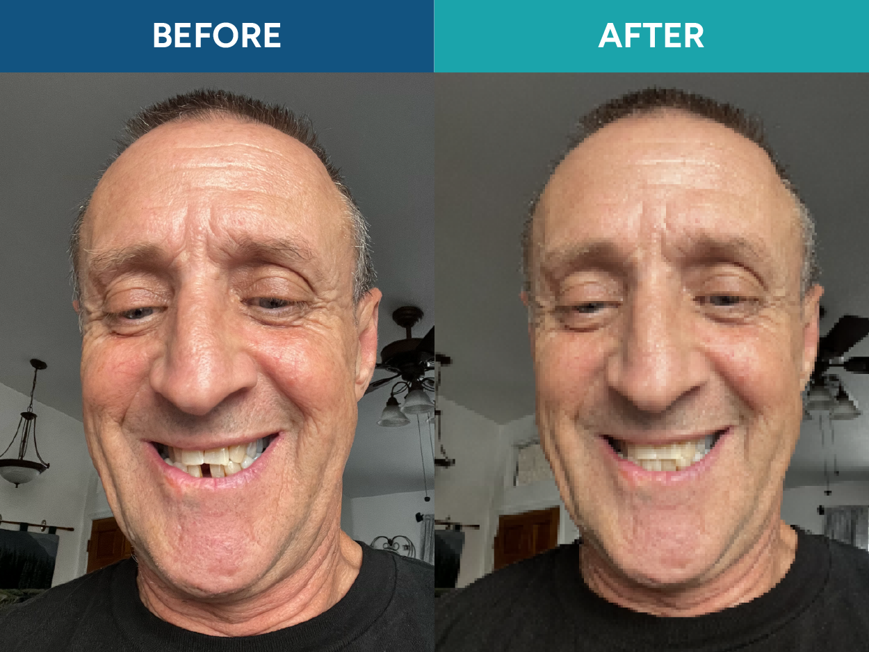Before and after comparison of a person missing a lower tooth, followed by the same person wearing a ResetSmile partial denture.