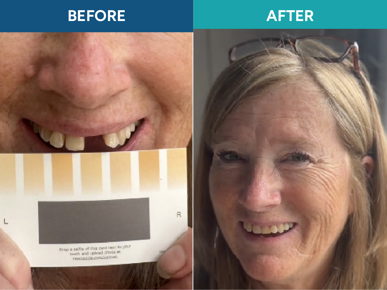 Before and after comparison of a person with dental issues and a color chart, followed by a smiling person.