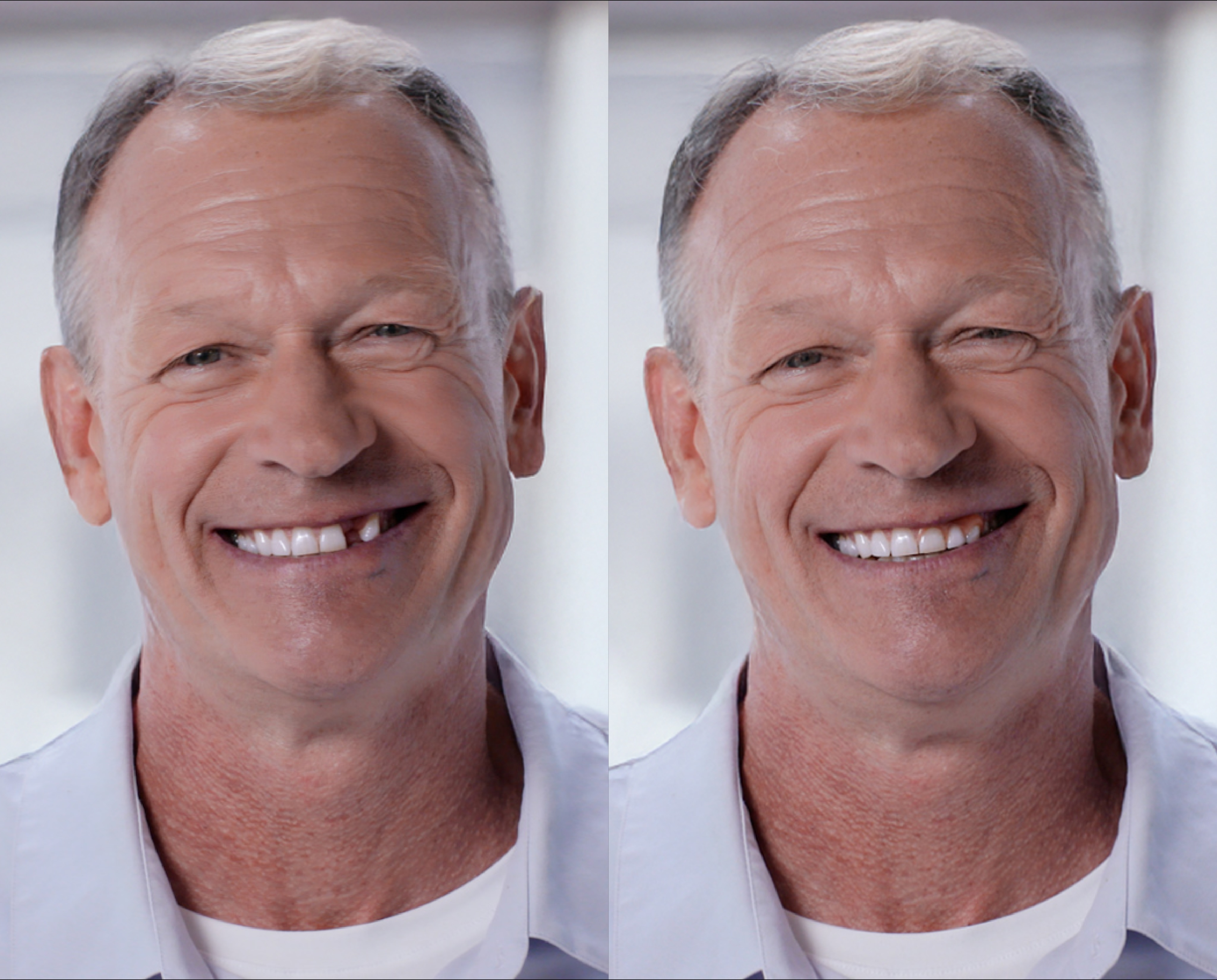 Greg smiling before and after ResetSmile